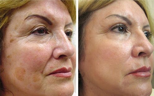 Anna from Wroclaw achieved a noticeable effect in smoothing wrinkles and firming the facial contour after using Canabilab
