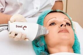 fractional rejuvenation of the skin of the face with laser