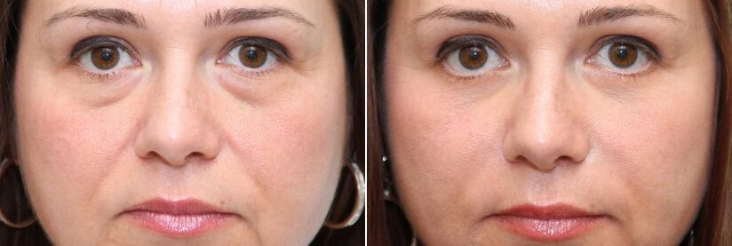 Before and after blepharoplasty removal of the adipose body under the eyes and skin firming