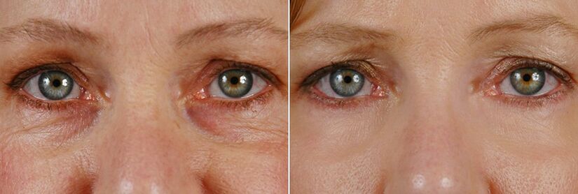 Before and after laser surgery rejuvenation of the skin around the eyes