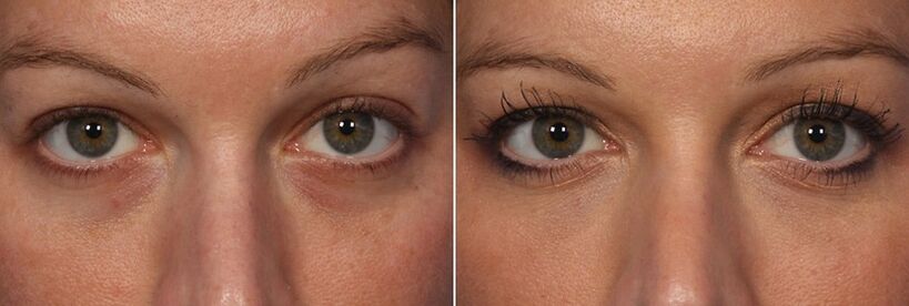 Before and after using injectable fillers - reduction of dark circles